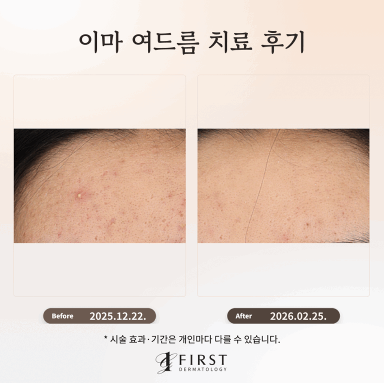 수원 이마 여드름 치료 후기