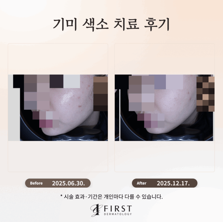 30대 기미·색소 침착 치료 후기