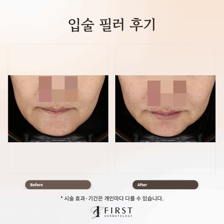 피부과 입술필러 후기