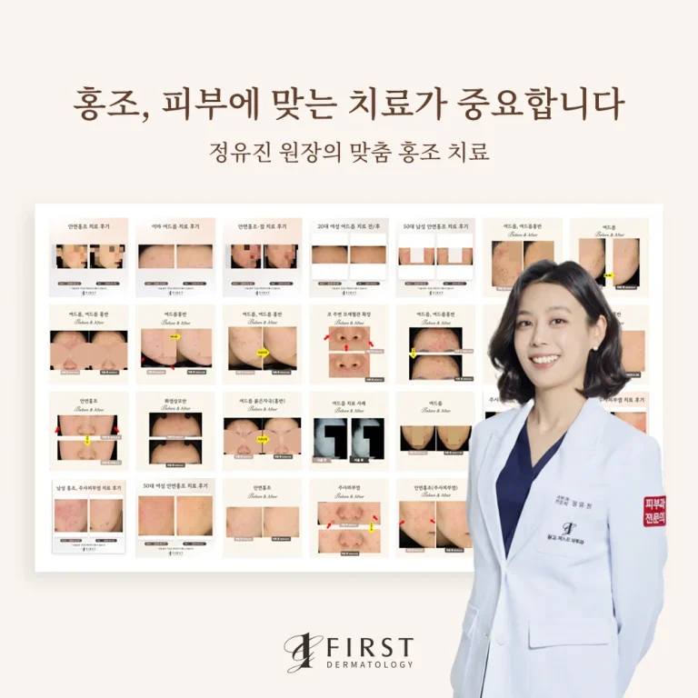 안면홍조 치료 방법