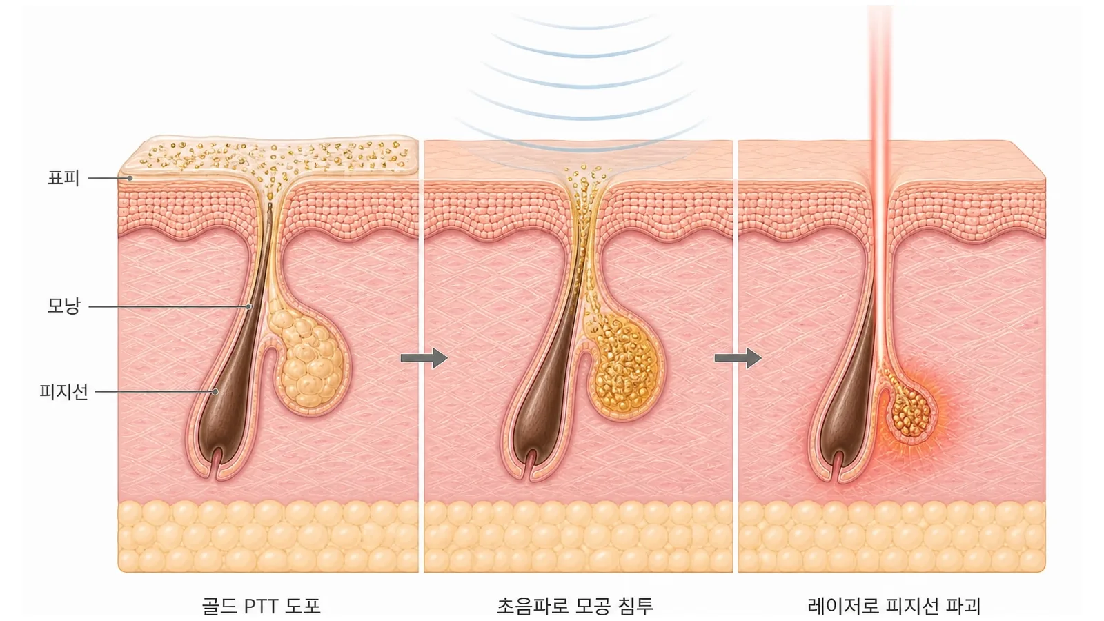 골드 PTT 원리 — 금 나노입자 도포, 초음파로 모공 침투, 레이저로 피지선 파괴의 3단계 피부 단면 도해