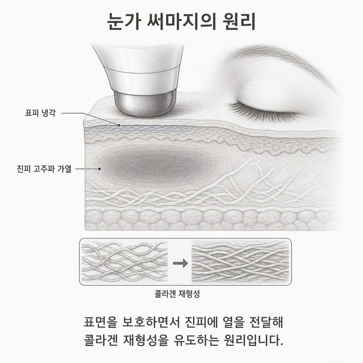 표피를 냉각하면서 진피에 고주파 열을 전달해 콜라겐 재형성을 유도하는 눈가 써마지 도식