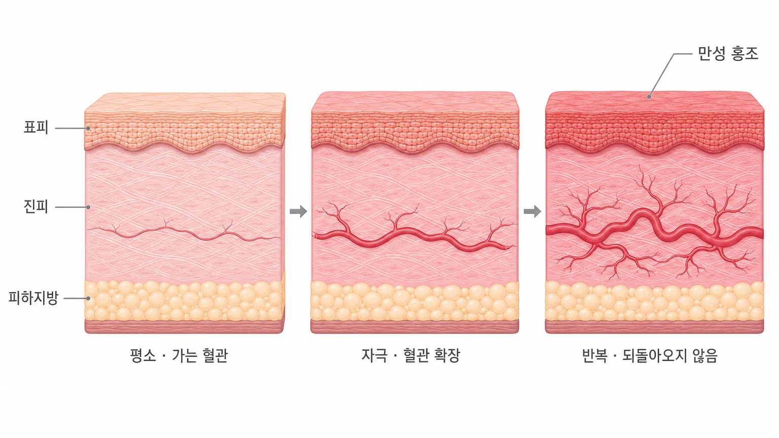 안면 홍조가 생기는 원리 — 자극을 받으면 혈관이 확장되고, 반복되면 되돌아오지 않아 만성 홍조로 남는 피부 단면 도해