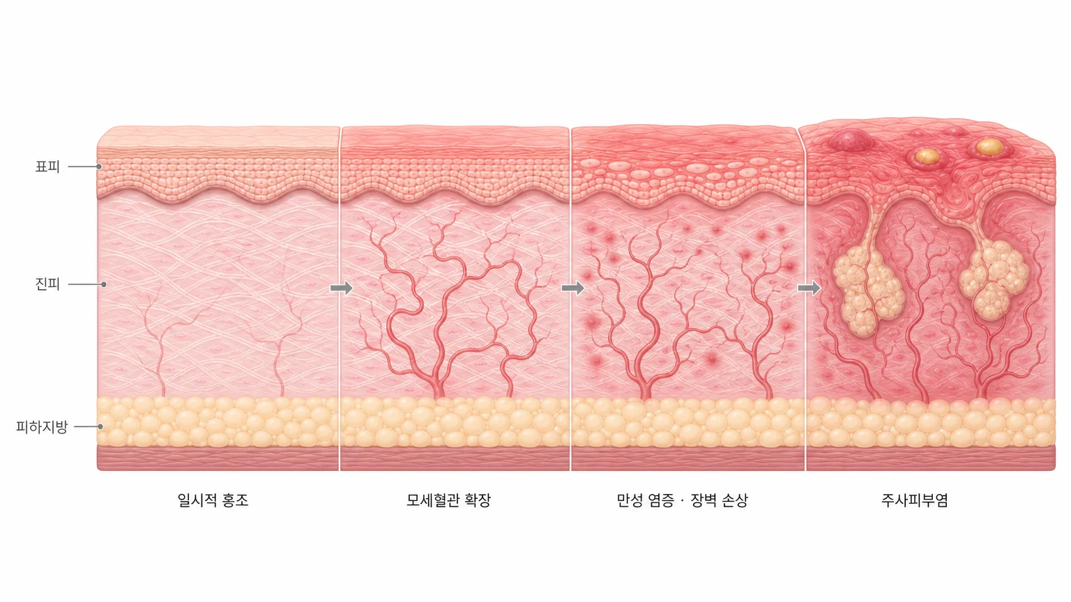 주사피부염에서 관찰할 수 있는 홍반과 혈관 확장, 구진의 임상 양상