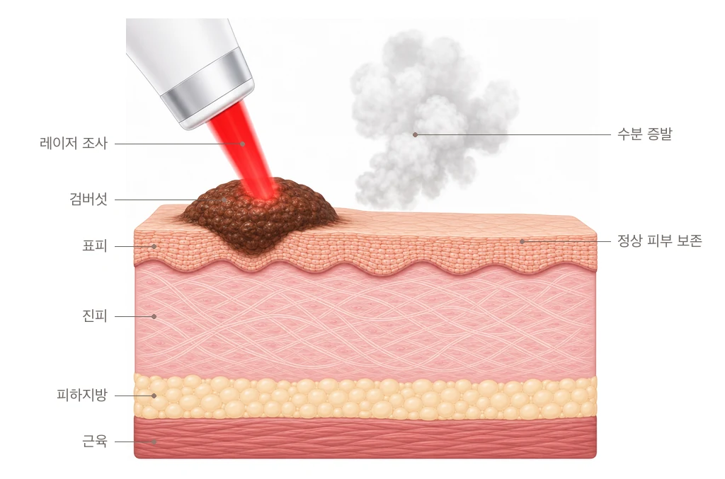 CO2 레이저가 피부 위로 솟은 검버섯만 정밀하게 증발시켜 깎아내는 원리를 그린 피부 단면 도해