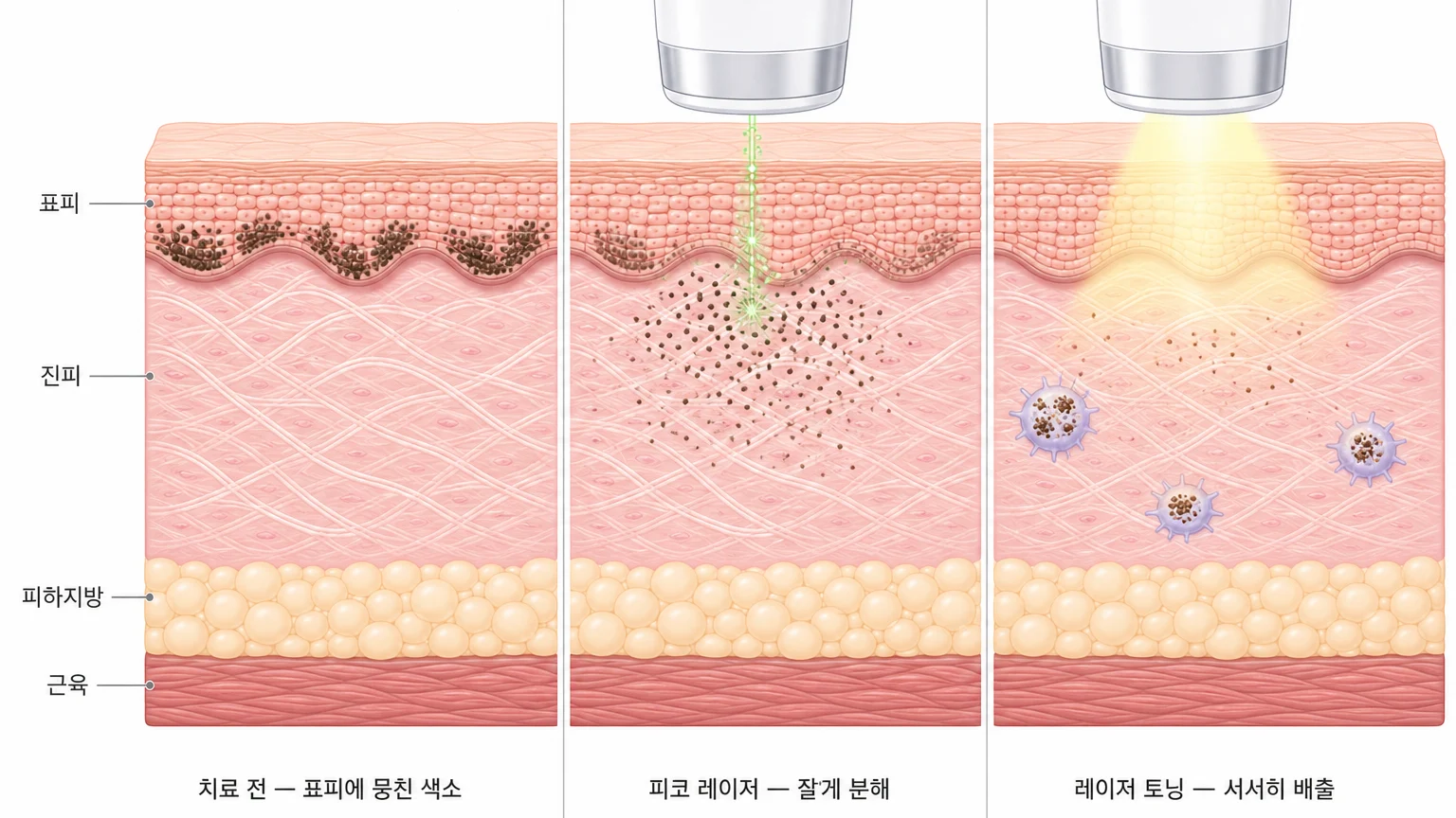 흑자를 피코 레이저로 잘게 분해한 뒤 레이저 토닝으로 남은 색소를 배출시키는 2단계 치료 도해