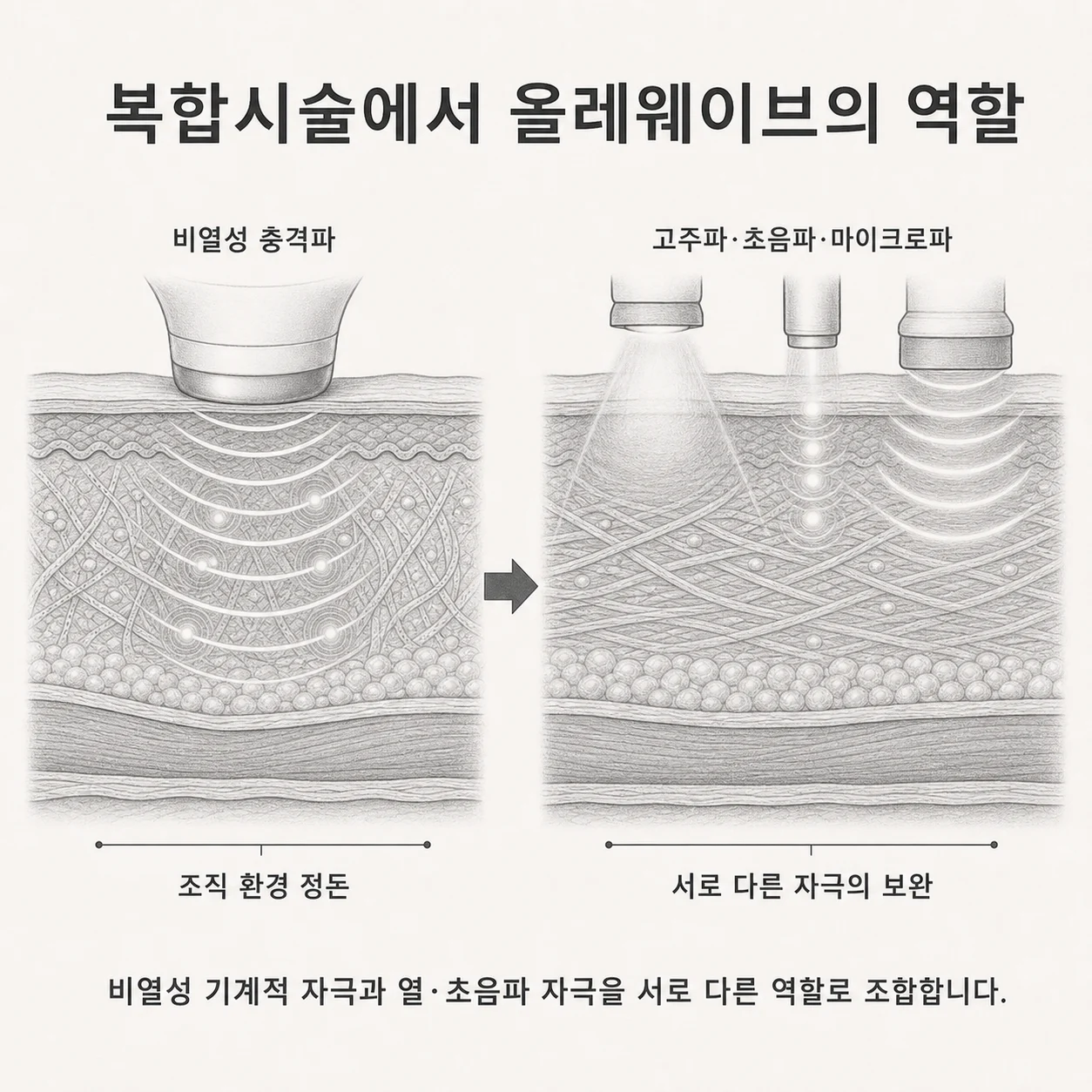 올레웨이브 비열성 충격파와 고주파 초음파 마이크로파 자극의 상호 보완을 설명하는 복합시술 도식
