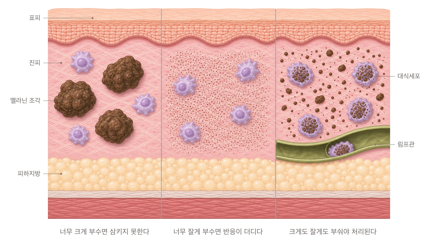 부순 멜라닌 조각의 크기에 따라 대식세포의 처리가 어떻게 달라지는지 세 칸으로 비교한 피부 단면 도해 — 너무 크게 부수면 삼키지 못하고, 너무 잘게 부수면 반응이 더디며, 크게도 잘게도 부숴야 대식세포가 삼켜 림프관으로 내보낸다