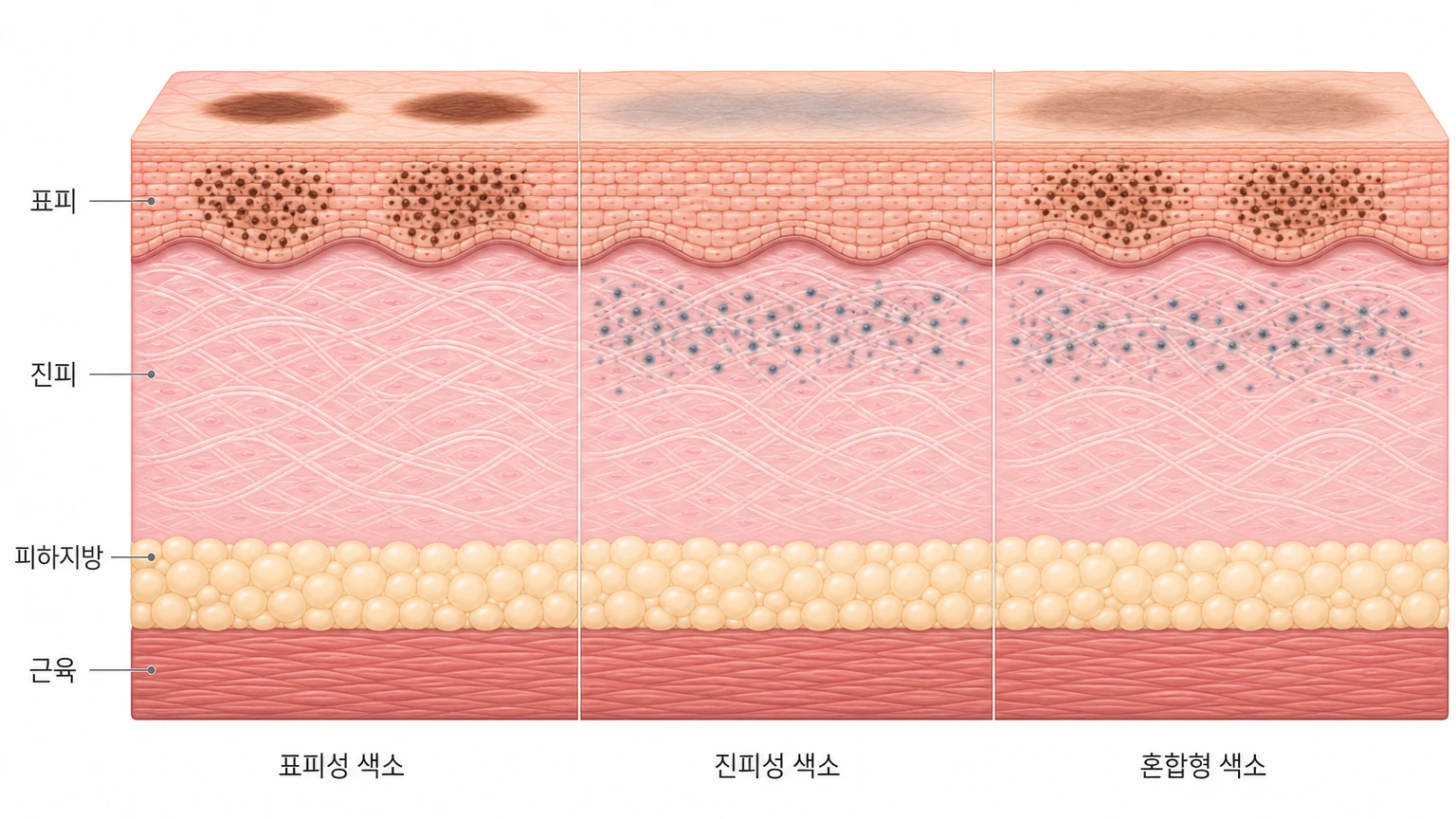 색소가 자리 잡은 깊이에 따라 표피성·진피성·혼합형으로 나뉘는 색소질환을 나란히 비교한 피부 단면 도해