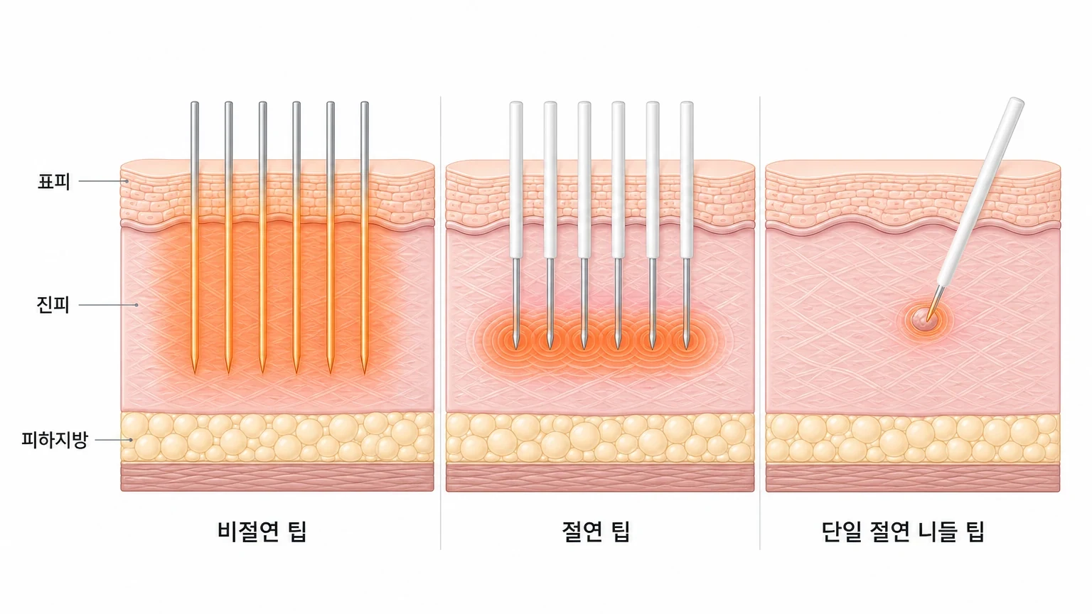 비절연 팁은 표피와 진피 전층에 고주파를 고르게 전달하고, 절연 팁은 표피를 보호한 채 진피에만, 단일 절연 니들 팁은 작고 얕은 병변 한 곳에만 에너지를 넣는 세 가지 포텐자 팁을 나란히 비교한 피부 단면 도해