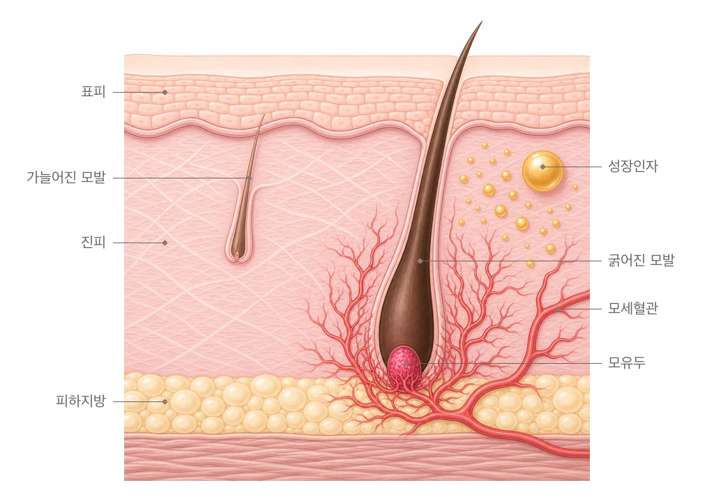 두피 진피에 주입된 성장인자가 모유두와 모낭을 감싼 모세혈관을 늘려 가늘던 모발이 굵게 자라도록 돕는 원리를 그린 두피 단면 도해