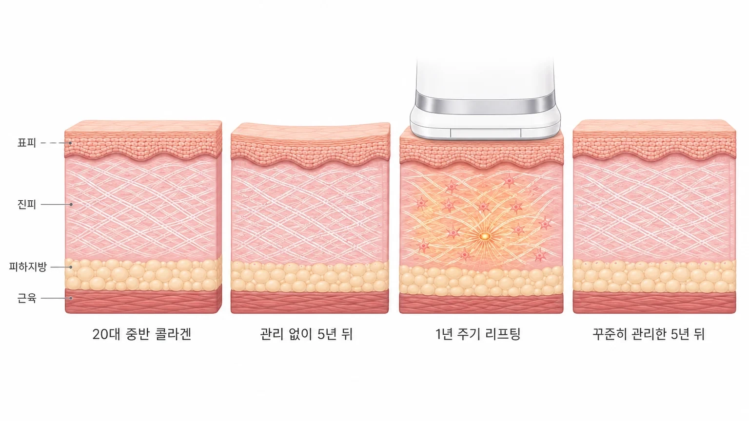 20대 중반의 콜라겐, 관리 없이 5년이 지난 진피, 1년 주기 리프팅 시술, 꾸준히 관리한 5년 뒤를 좌우로 비교한 콜라겐 소실 방지 4단계 피부 단면 도해