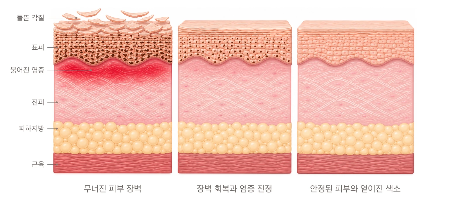 들뜬 각질과 붉어진 염증으로 무너진 피부 장벽이 회복되며 염증이 가라앉고 색소가 옅어지는 세 단계를 좌우로 나열한 피부 단면 도해