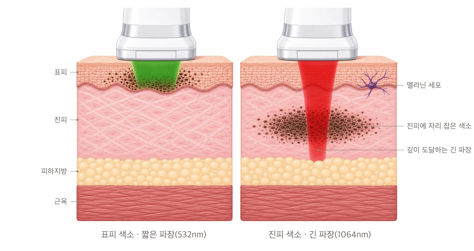 표피에 자리 잡은 색소는 짧은 파장(532nm)이, 진피 깊은 곳의 색소는 긴 파장(1064nm)이 도달해야 한다는 것을 보여 주는 색소 깊이별 레이저 파장 비교 피부 단면 도해