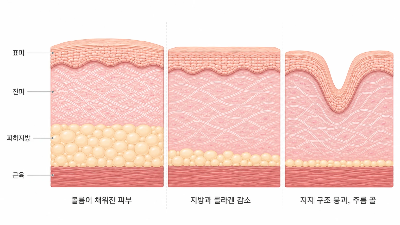 나이가 들며 피하지방과 콜라겐이 줄어 지지 구조가 무너지고 주름 골이 파이는 과정을 세 단계로 비교한 피부 단면 도해