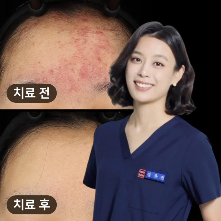 여드름 붉은 자국, 홍반 치료 방법