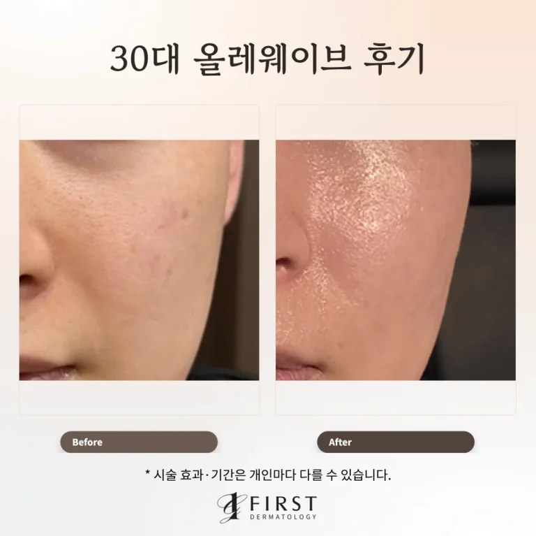 30대 남성 올레웨이브 후기: 볼 피부결과 탄력 관리
