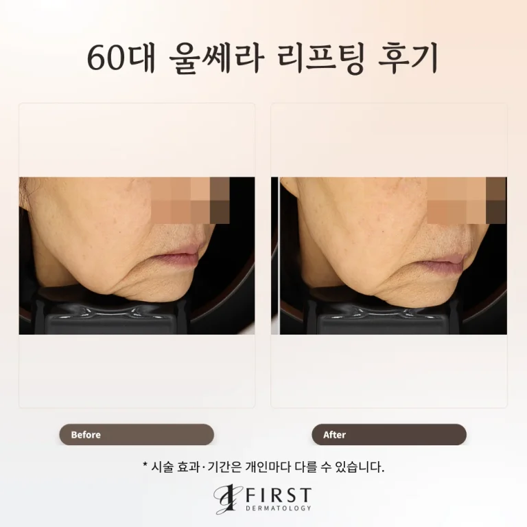 60대 울쎄라 리프팅 후기: 팔자주름과 입가 처짐 개선