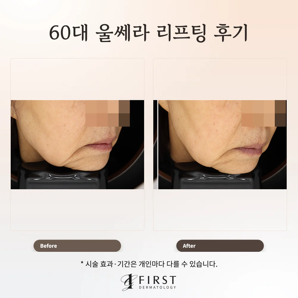 60대 여성 팔자주름·입가 처짐 울쎄라 리프팅 치료 전후 비교 사진