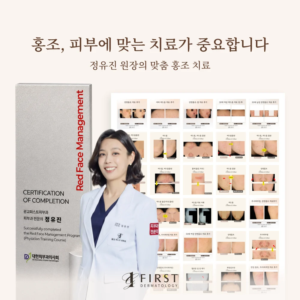 홍조 치료 후기