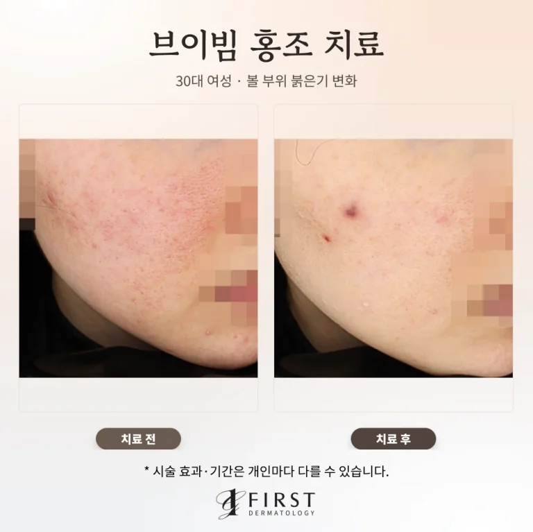 30대 여성 브이빔 홍조 치료: 볼의 붉은기 변화