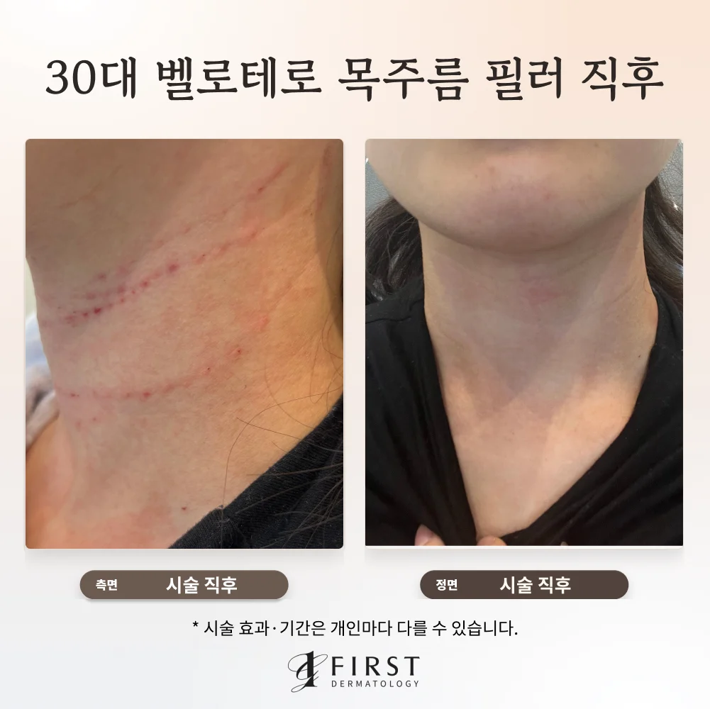 30대 여성 벨로테로 목주름 필러 시술 직후 측면과 정면 목 사진
