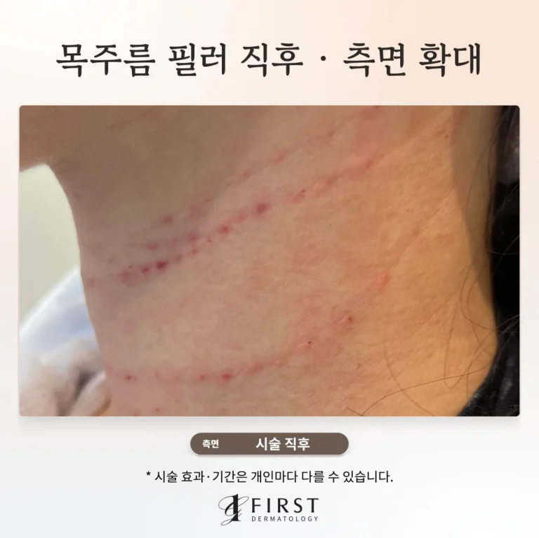 벨로테로 목주름 필러 시술 직후, 30대 여성 목 가로주름 주입 모습