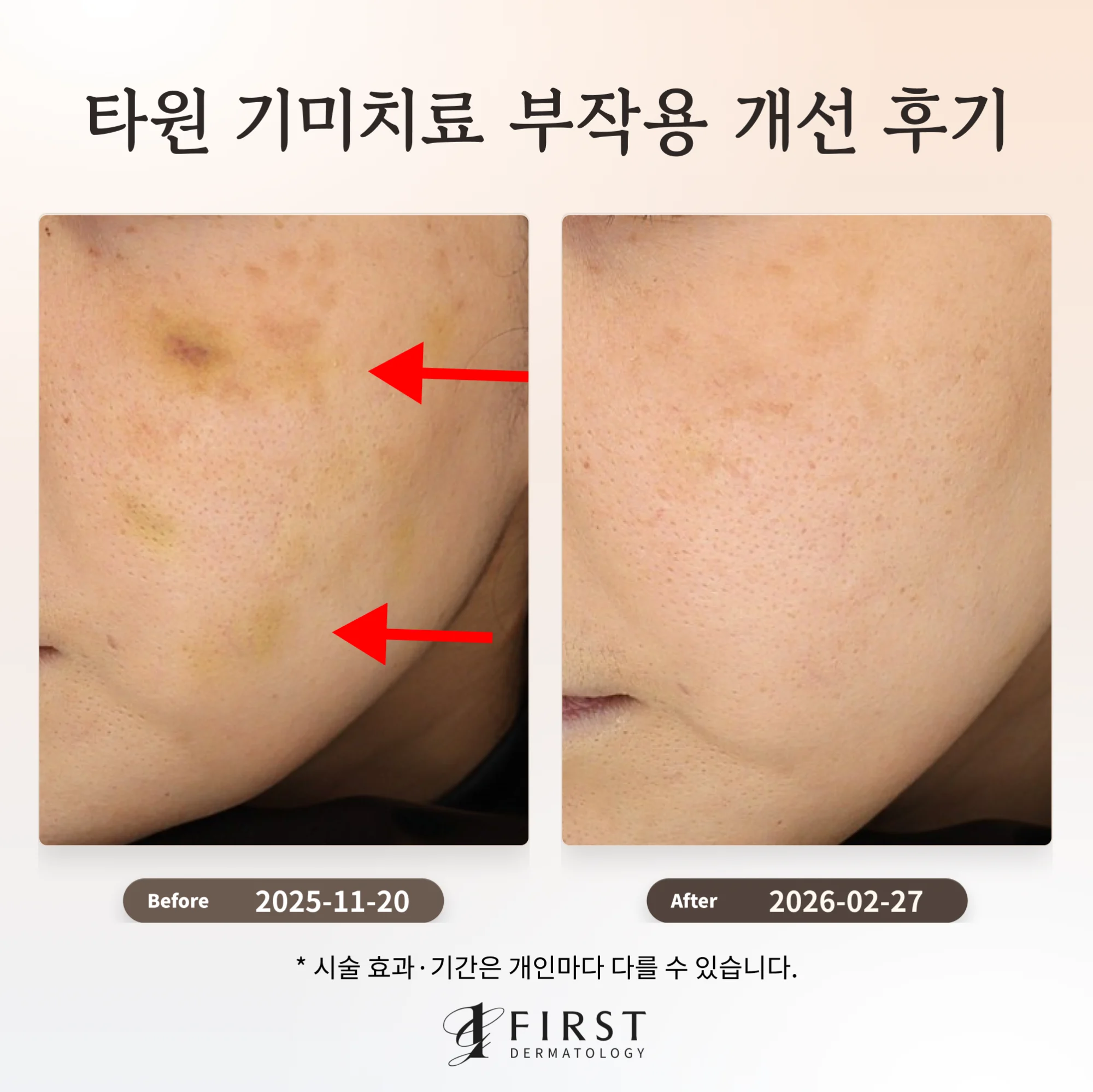 20대 여성 왼쪽 볼, 시술 뒤 남은 누런 멍 자국과 색소가 토닝 치료 후 옅어진 전후 비교