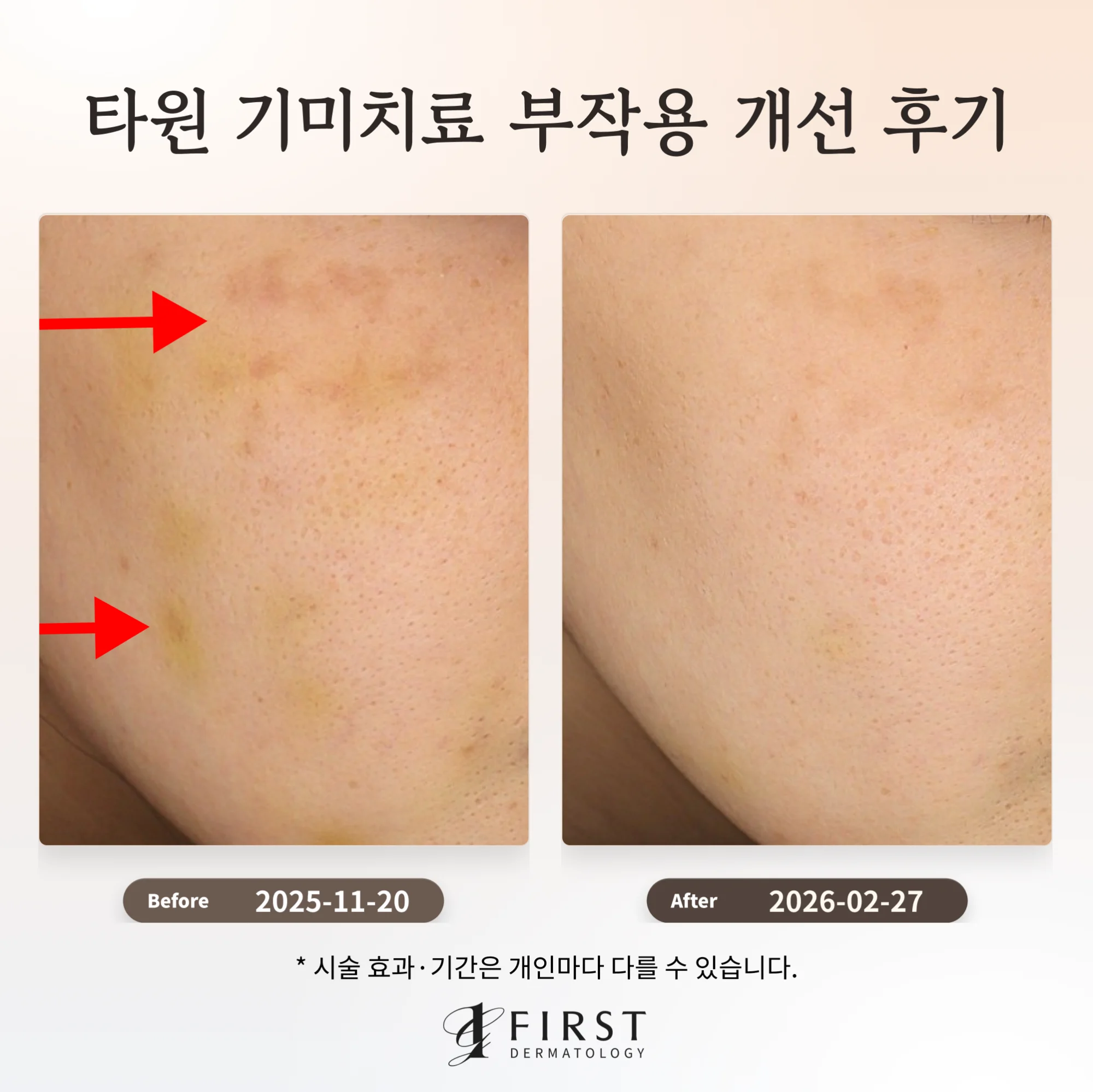 20대 여성 오른쪽 볼, 광대 아래 번진 색소 자국과 누런 멍이 토닝 치료 후 옅어진 전후 비교