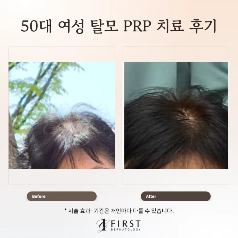 50대 여성 탈모 PRP 치료 5회 후기