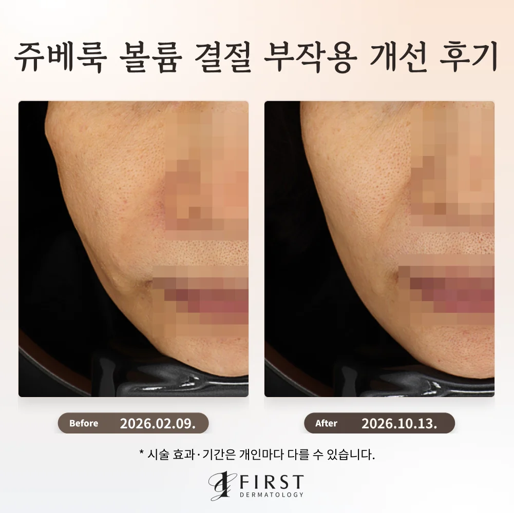 쥬베룩 볼륨 시술 후 생긴 볼 결절의 치료 전후 정면 사진. 왼쪽은 치료 전, 오른쪽은 치료 후이며 코와 입은 모자이크 처리했다.