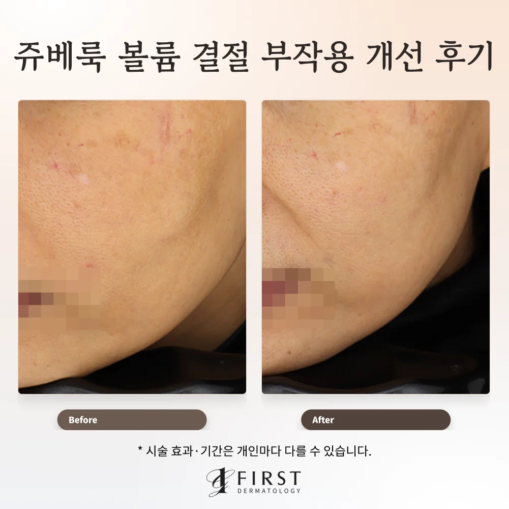 쥬베룩 볼륨 시술 후 생긴 볼 결절의 치료 전후 측면 사진. 왼쪽은 치료 전, 오른쪽은 치료 후이며 입은 모자이크 처리했다.