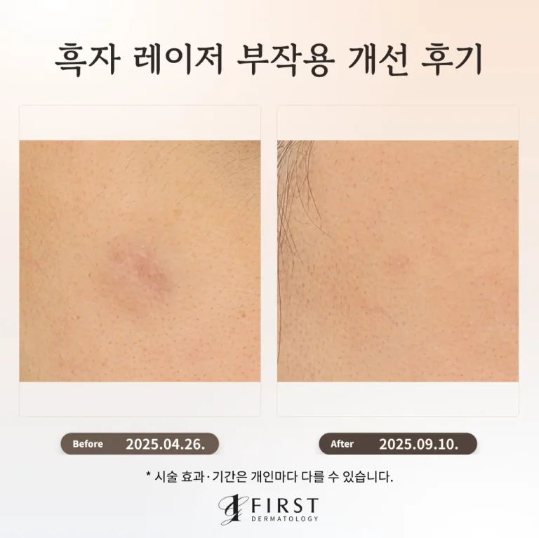 타 병원 레이저 흑자 제거 후 부작용, 피코토닝 치료 후기