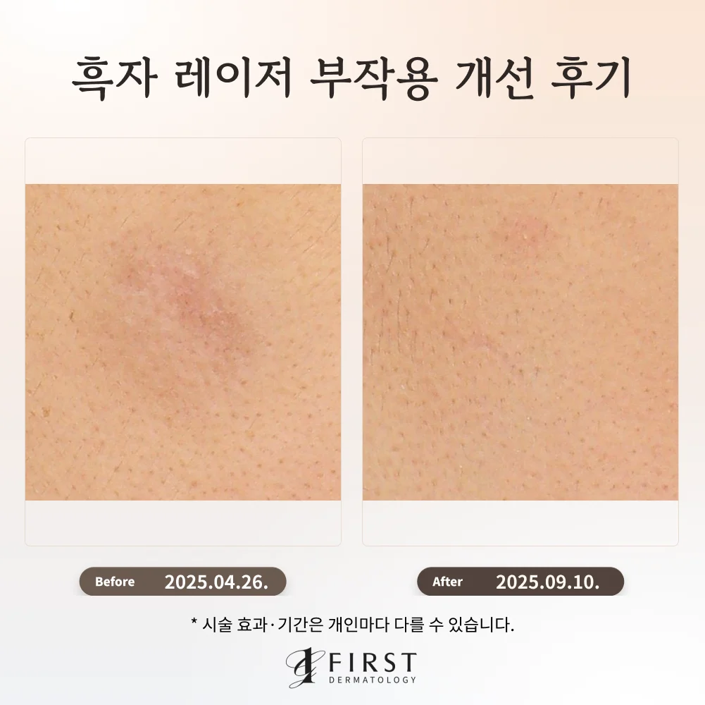 흑자 레이저 부작용 부위를 확대한 피코토닝 치료 전후 사진. 왼쪽은 치료 전, 오른쪽은 치료 후이다.