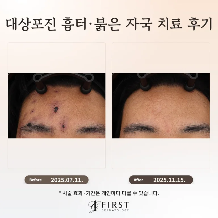 대상포진 후 이마 흉터·붉은 자국, 브이빔 치료 후기