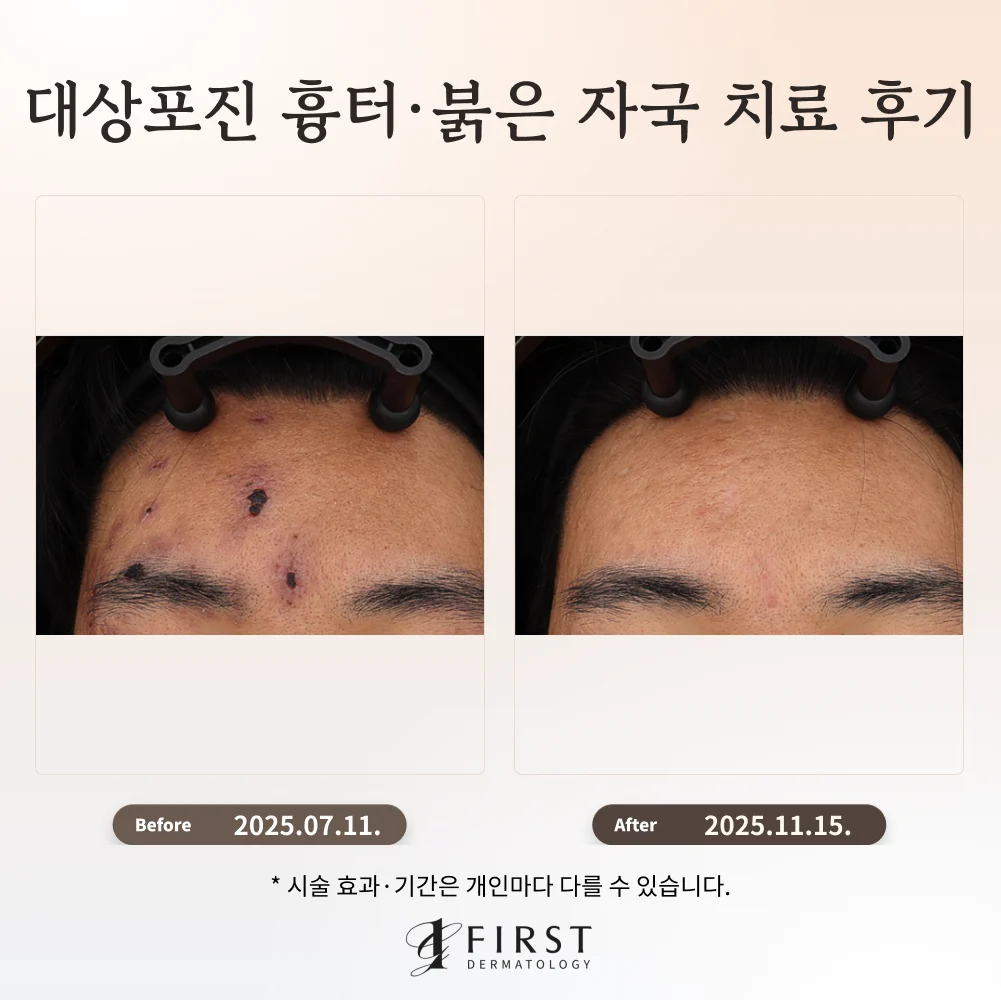 대상포진 후 이마에 남은 흉터와 붉은 자국의 브이빔 치료 전후 사진. 왼쪽은 치료 전, 오른쪽은 치료 후이다.