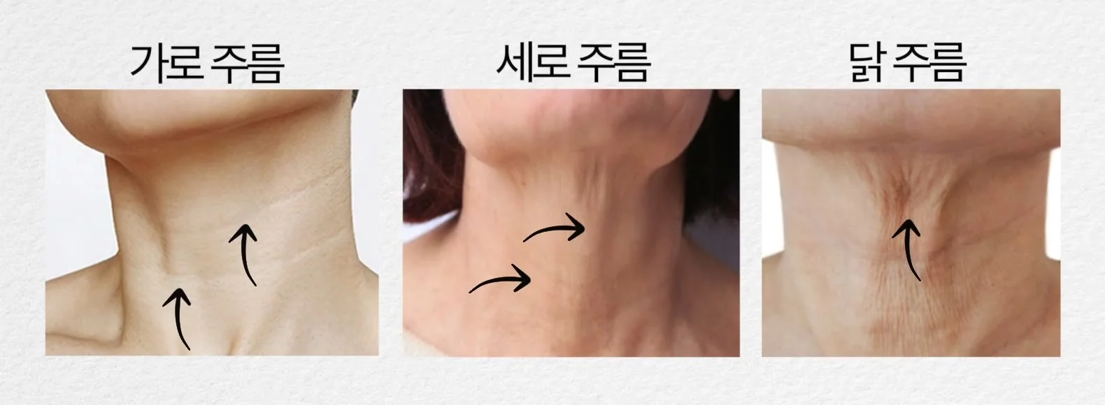 가로 주름, 세로 주름, 닭주름 세 가지 목주름 유형을 나란히 비교한 사진
