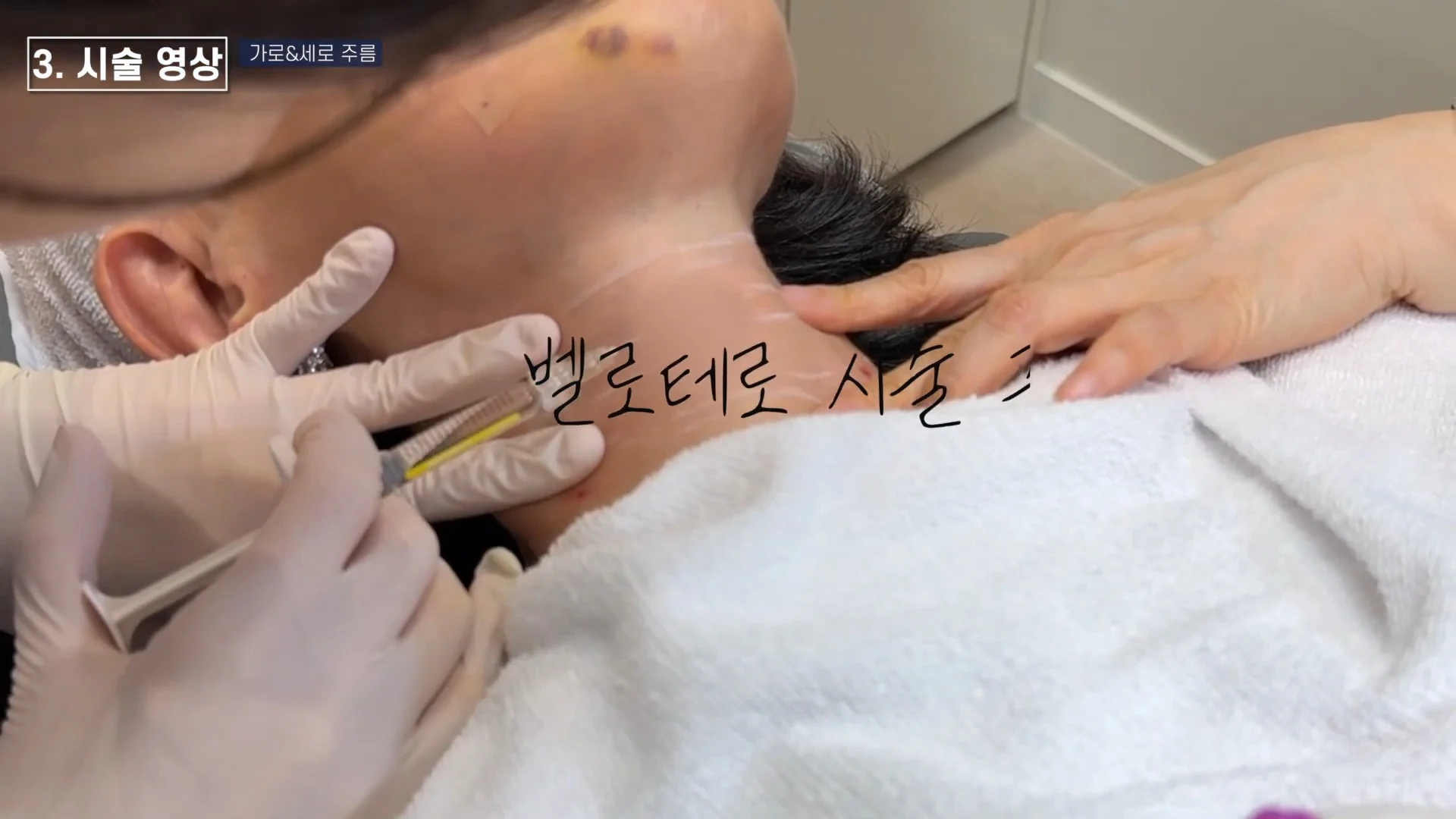 가로 목주름 선을 따라 벨로테로 필러를 주입하는 실제 시술 장면